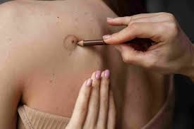 Mole Removal FAQs: Common Questions Answered