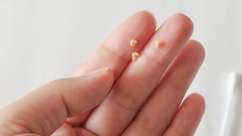 Why I Took Tonsil stone removal Healthpally Seriously After Ignoring the Signs